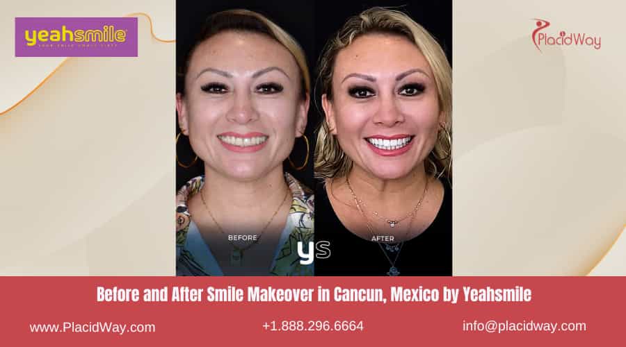 Before and After Smile Makeover in Cancun, Mexico by Yeahsmile