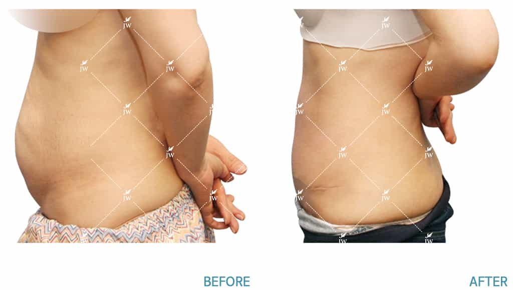 Body Contouring Before & After in PW Plastic Surgery in Seoul South Korea1