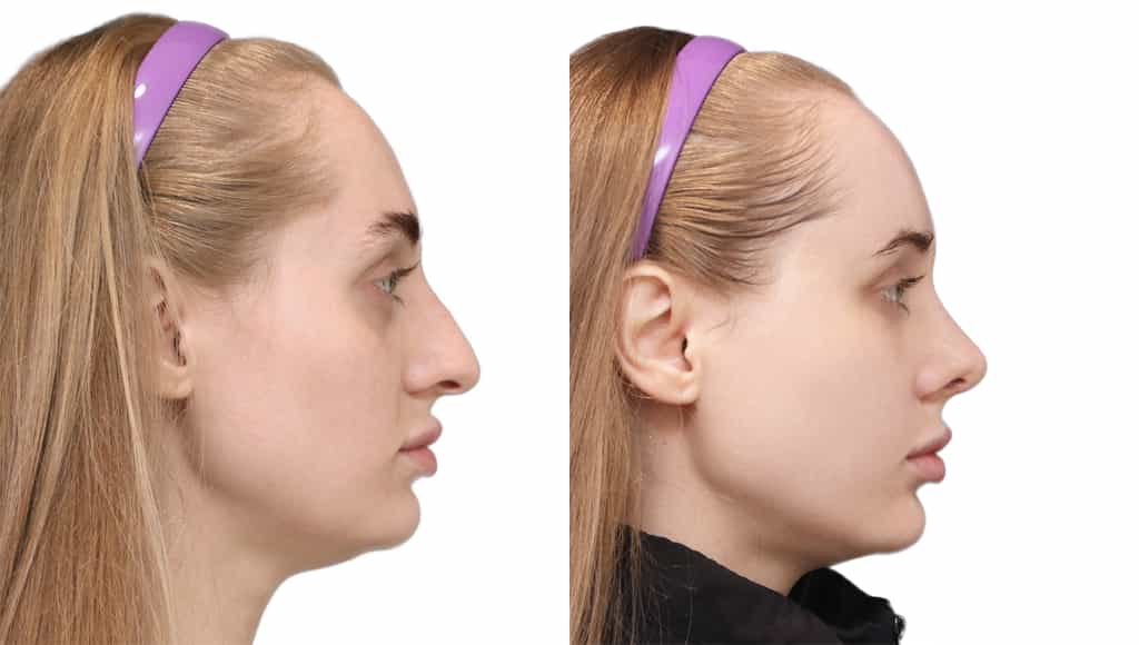 Rhinoplasty Before and After in JW Plastic Surgery in Seoul South Korea