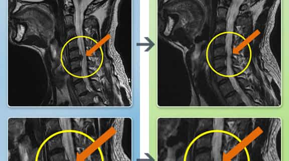 Before and After of Neck Pain MRI