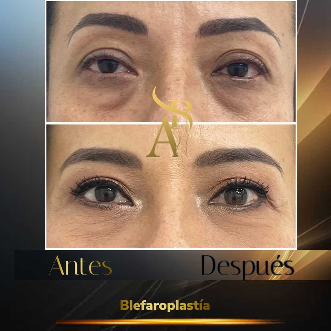 Before and After Eyelid Surgery in Tijuana Mexico