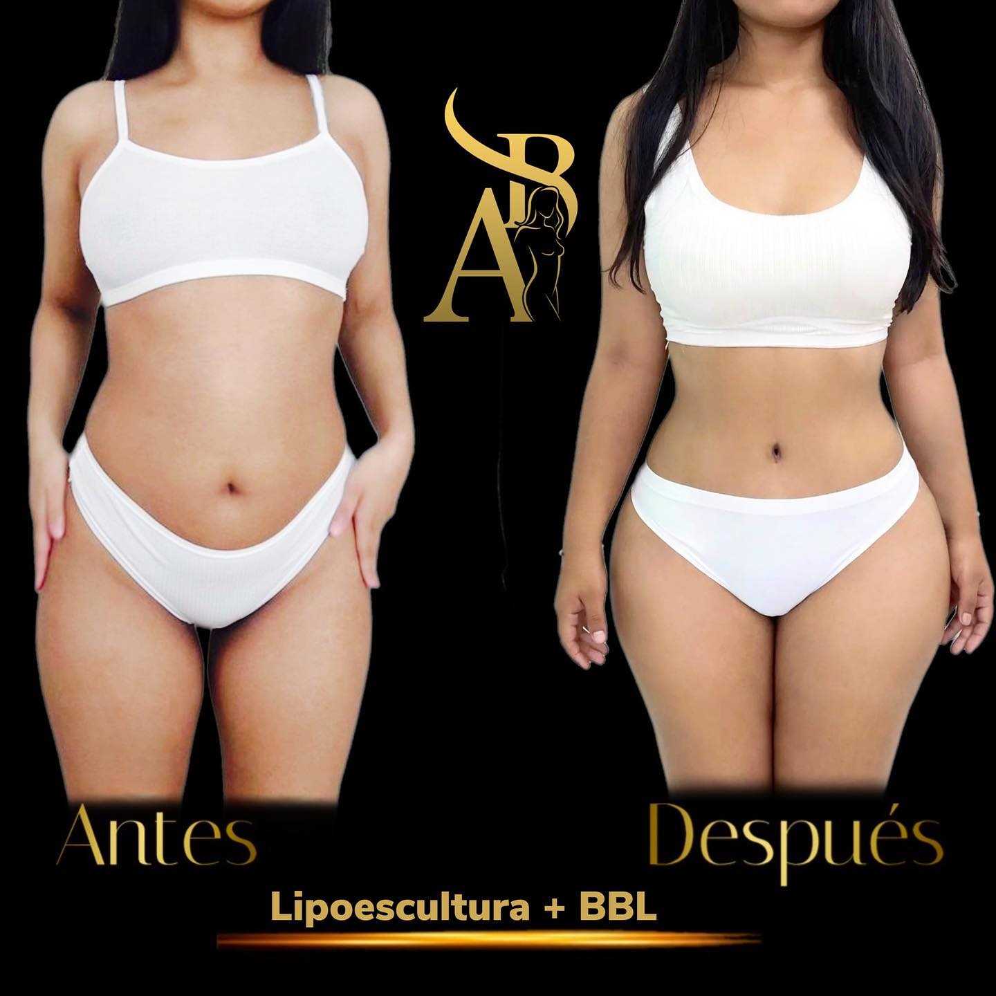 Before and After Liposuction with BBL in Tijuana Mexico