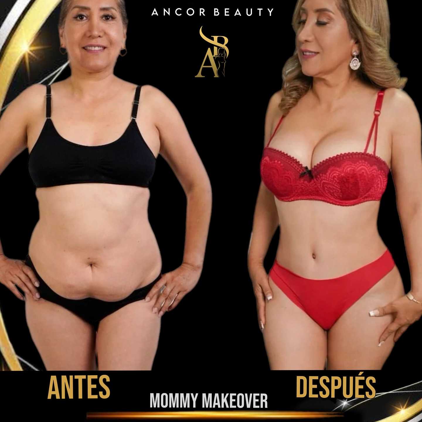 Antes y después de Mommy Makeover en Tijuana, México