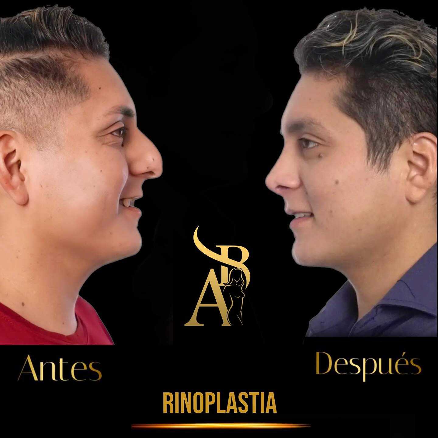 Before and After Rhinoplasty in Tijuana Mexico