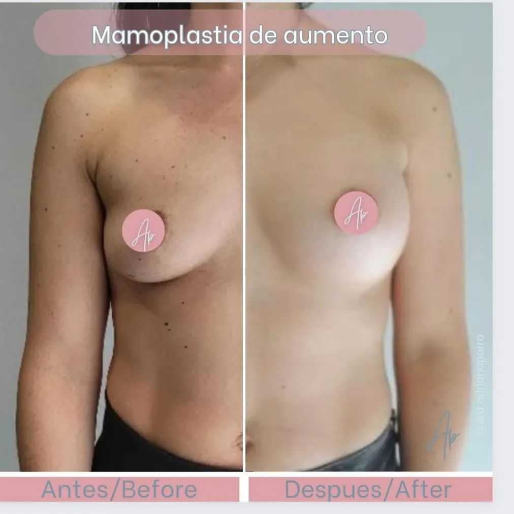 Before After Breast Reduction in Bogota Colombia