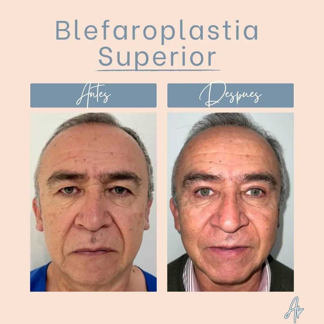 Before After Blepharoplasty in Bogota Colombia