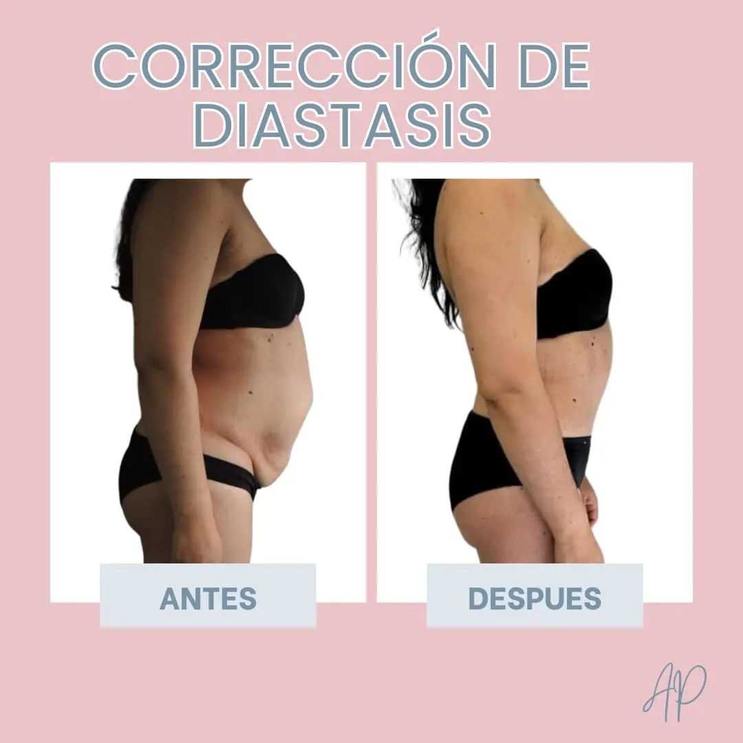 Antes y Después de Abdominoplastia en Bogotá Colombia