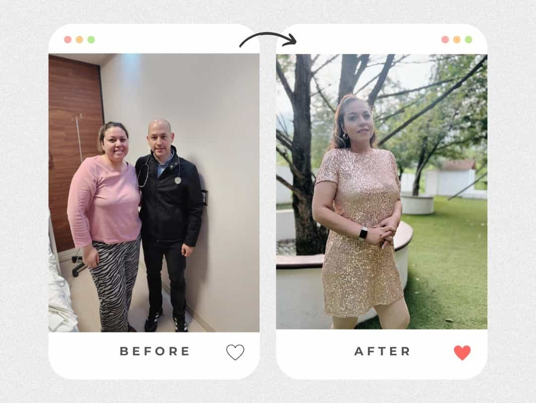 Before and After Bariatric Surgery in Piedras Negras Mexico