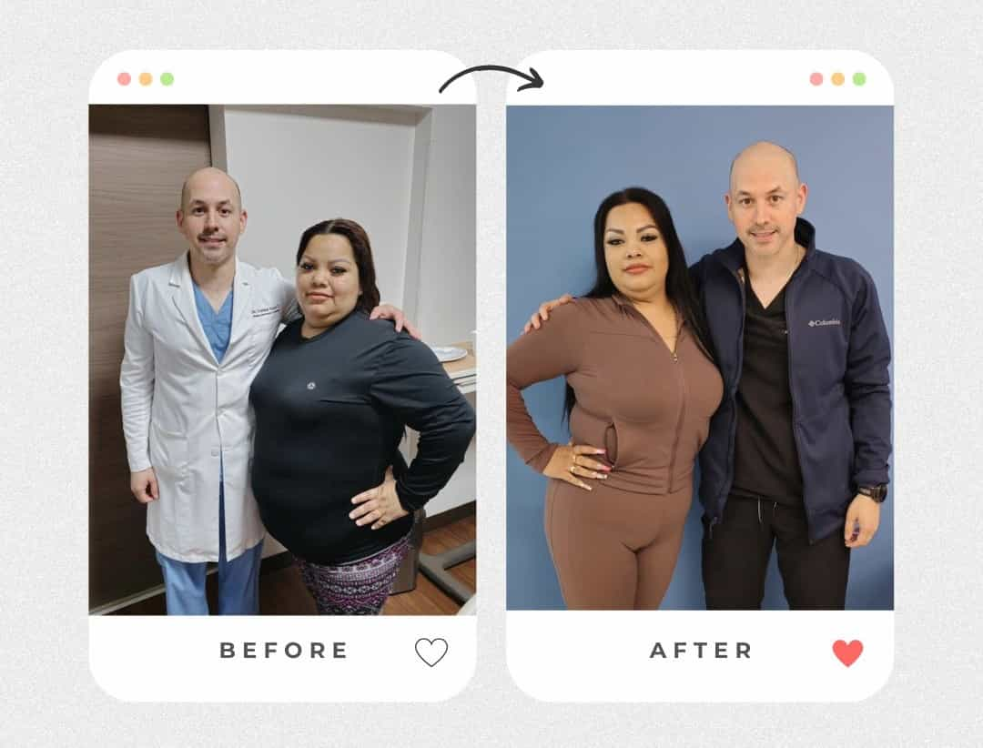 Before and After Gastric Sleeve Surgery in Piedras Negras Mexico