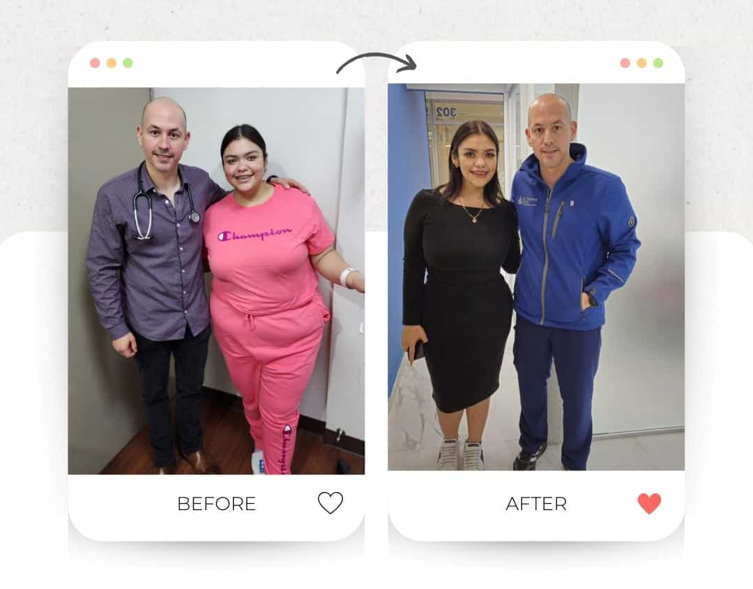 Before and After Gastric Sleeve Surgery in Piedras Negras Mexico