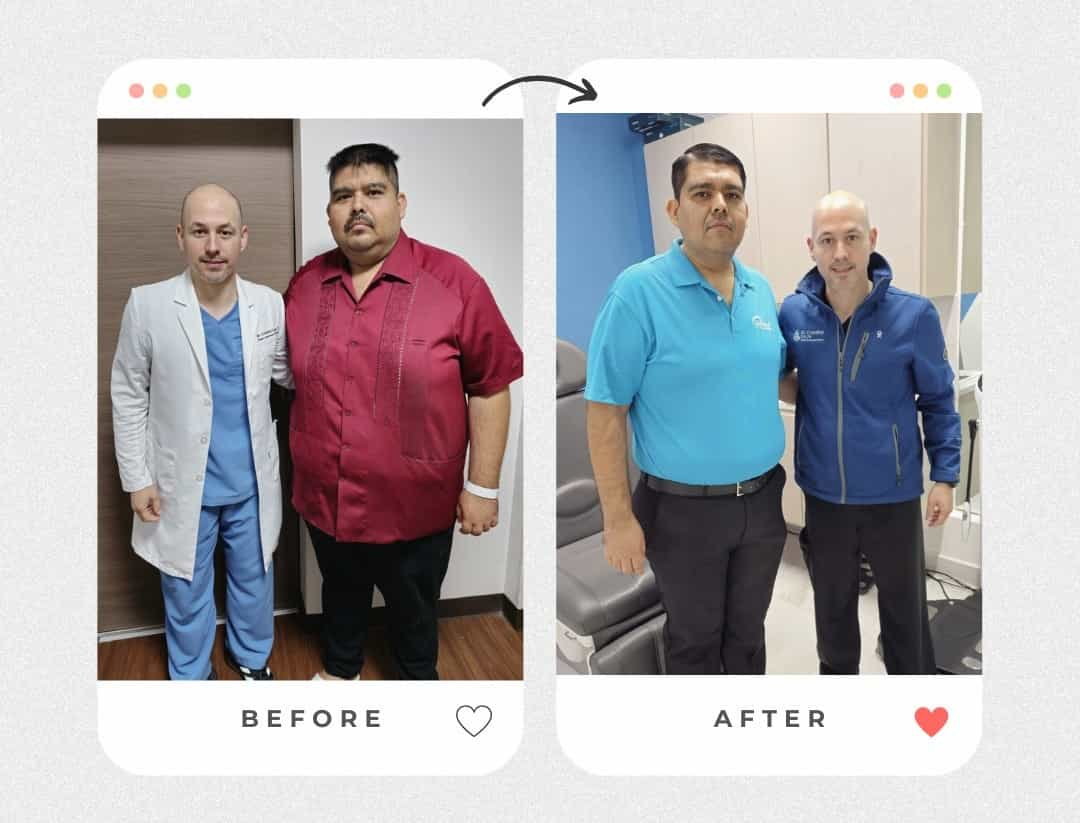 Before and After Obesity Surgery in Piedras Negras Mexico