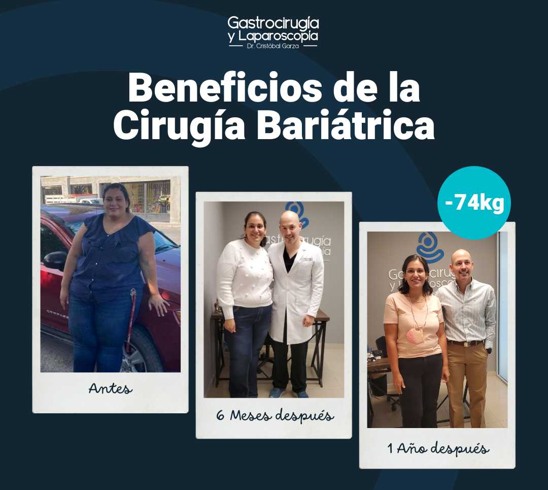 Bariatric Surgery in Mexico