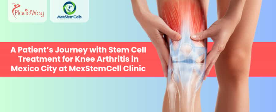 Stem Cell Therapy for Knee Arthritis in Mexico City