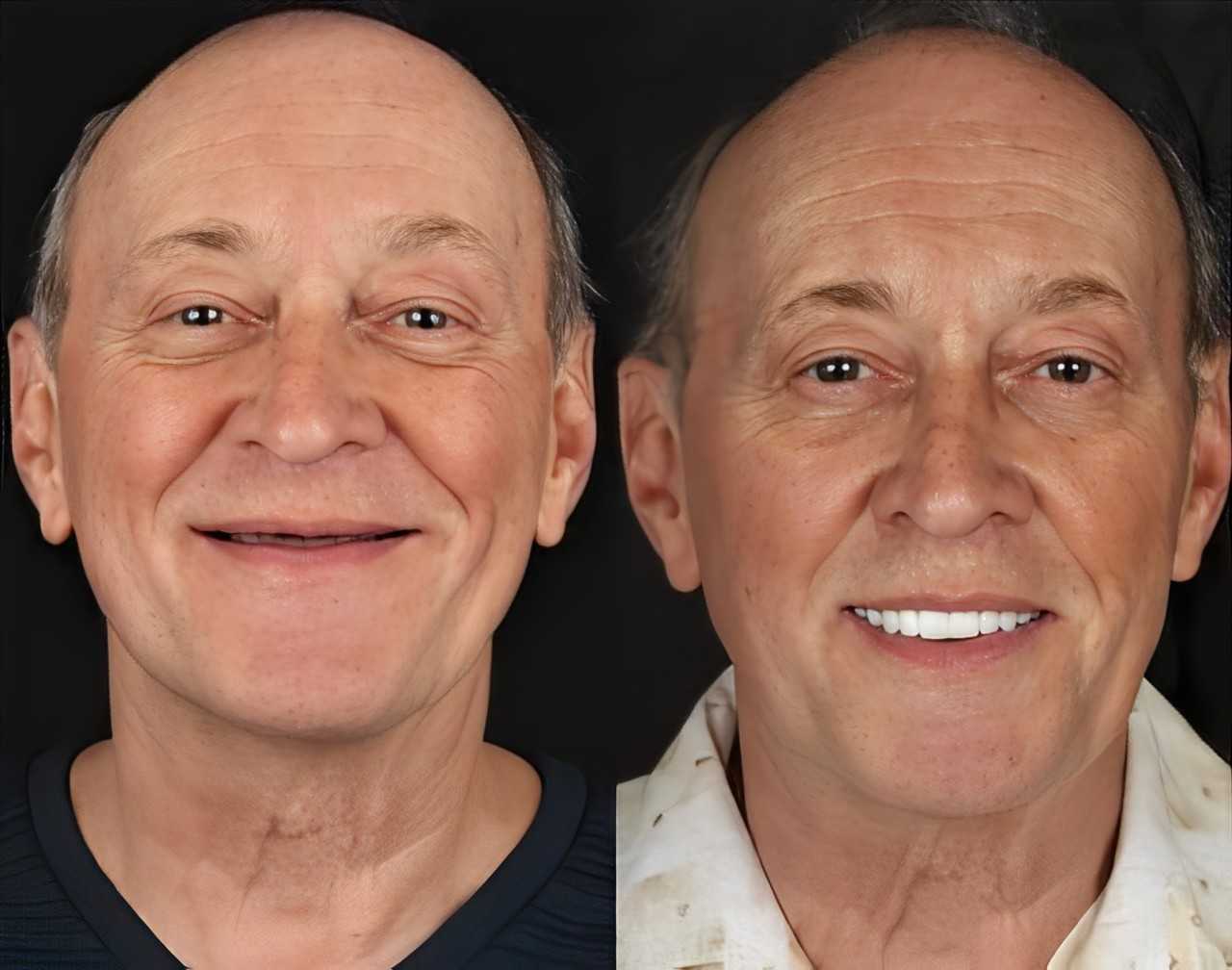 Before After All on 6 Dental Implants in Tijuana Mexico