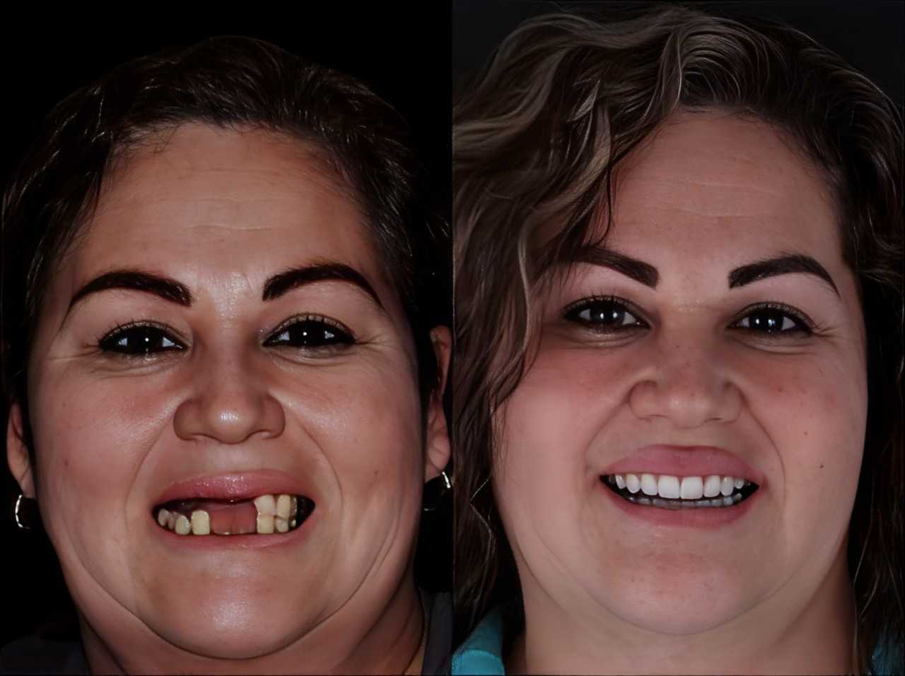 Before After Dental Implants in Los Algodones Mexico