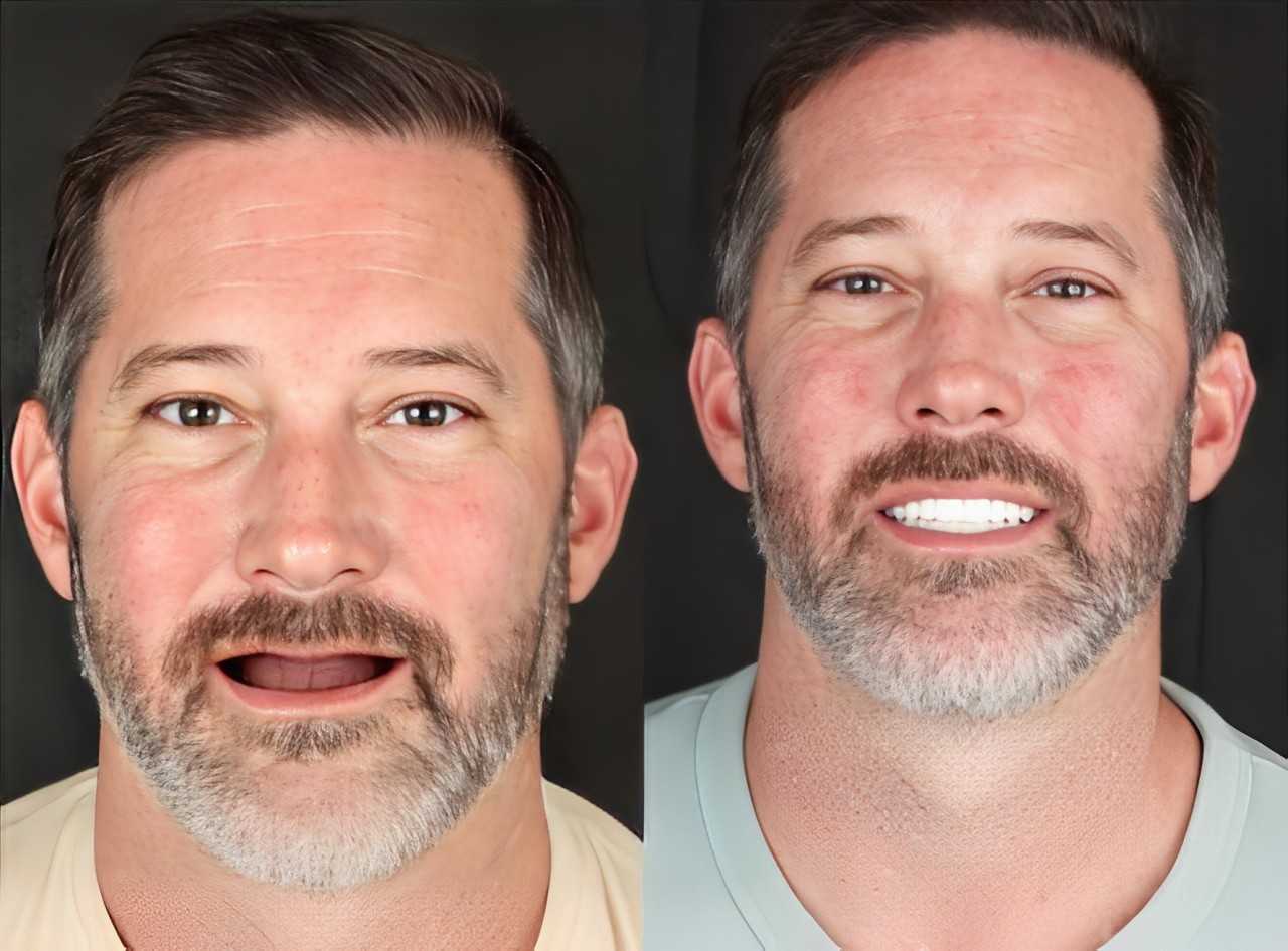 Before After Full Mouth Reconstruction in Tijuana Mexico