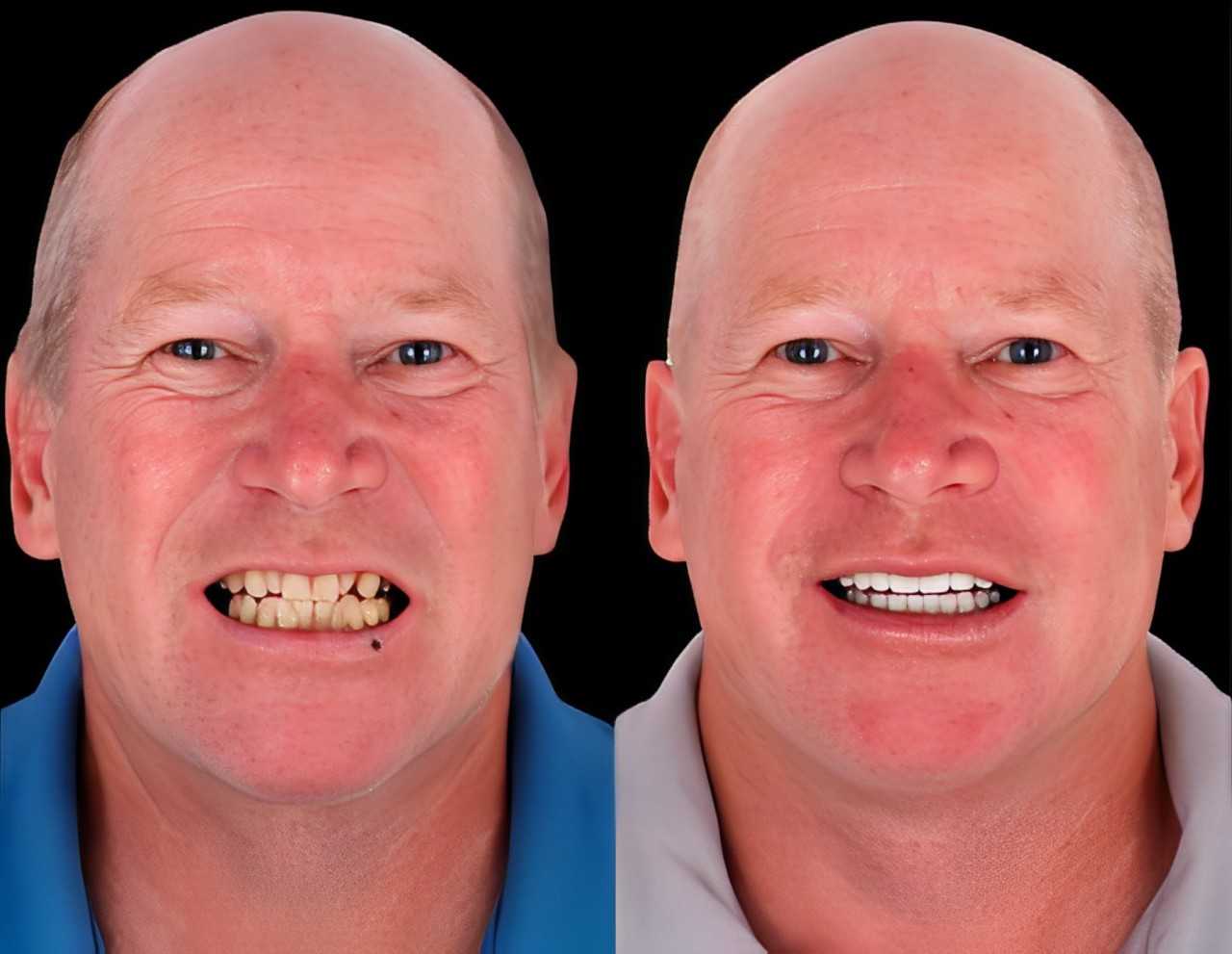 Before After Full Mouth Restoration in Los Algodones Mexico