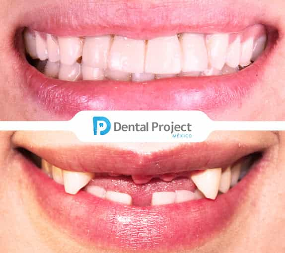 Imágenes de antes y después de implantes dentales en Tijuana, México