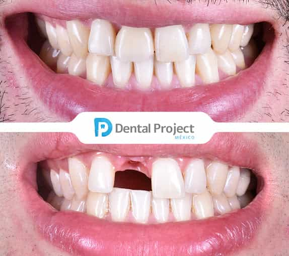 Imagen de antes y después de prótesis dental en Tijuana, México