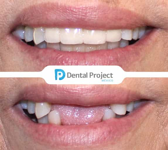 Before and After Image for Smile Makeover in Tijuana Mexico