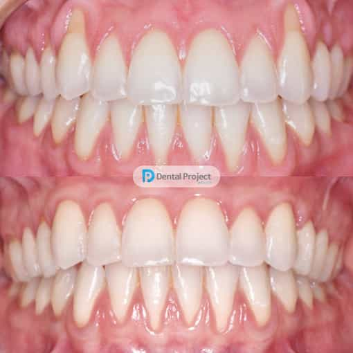 Imagen de antes y después de blanqueamiento dental en Tijuana, México