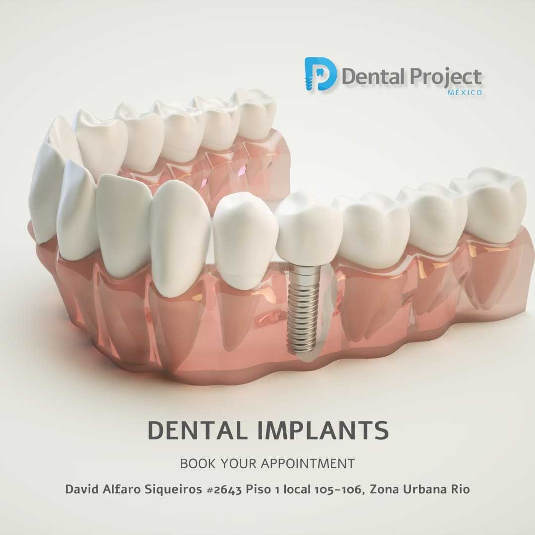 Implantes dentales en Tijuana México