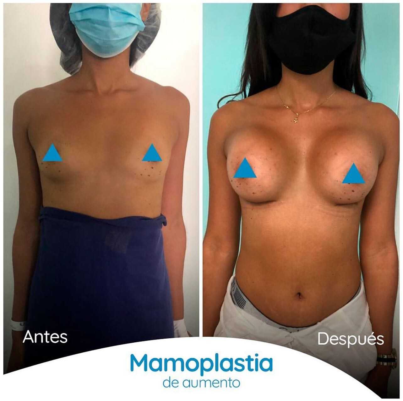 Before and After Image for Breast Augmentation in Colombia