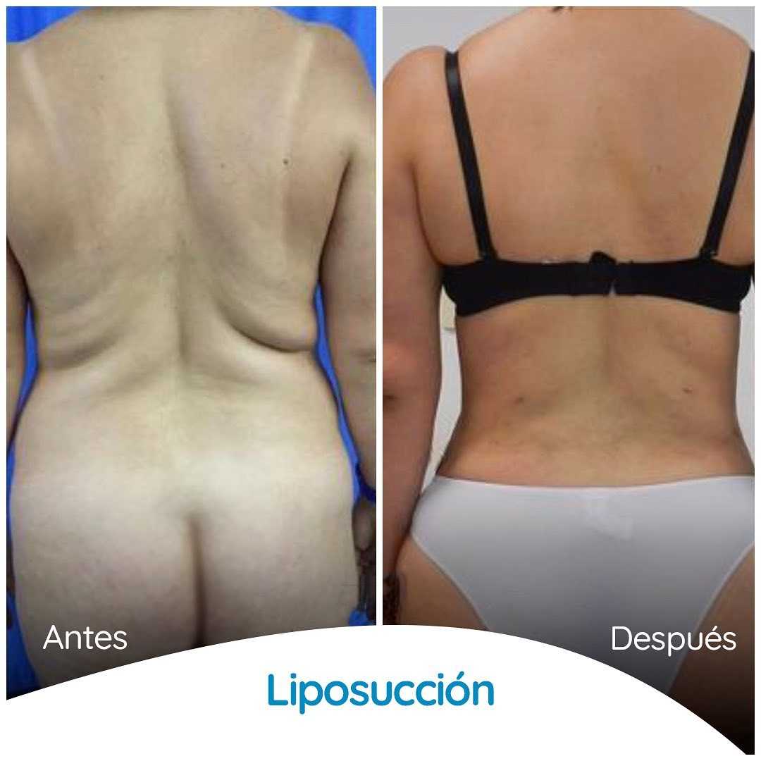 Imágenes de antes y después de una liposucción en Colombia