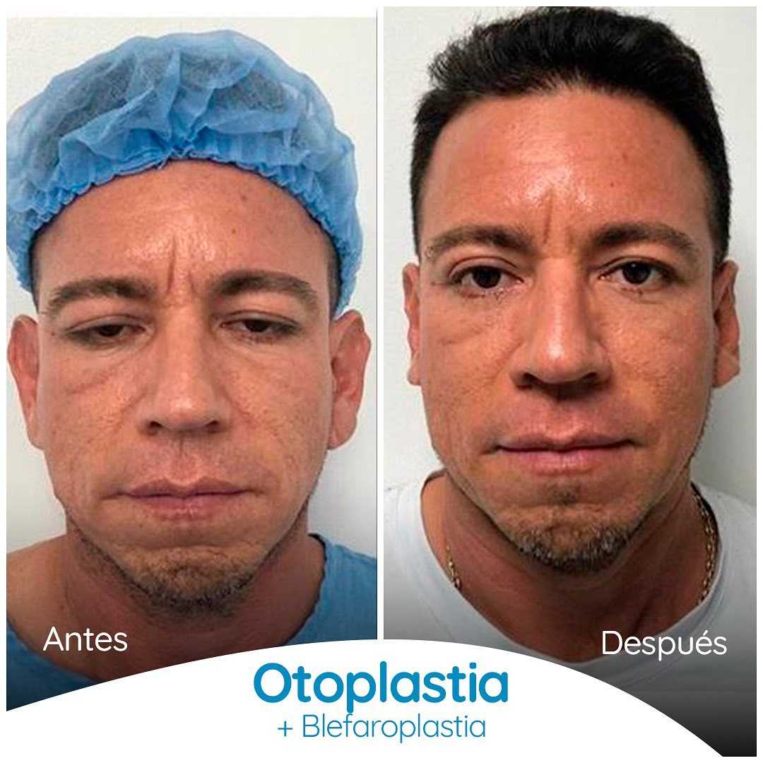 Imagen de Antes y Después de Otoplastia en Colombia