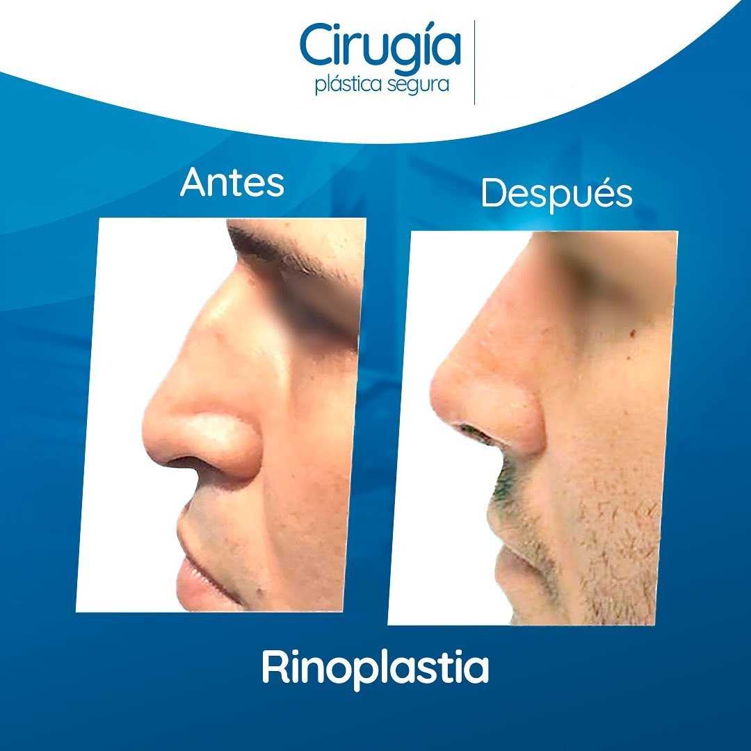 Imágenes de antes y después de una rinoplastia en Colombia