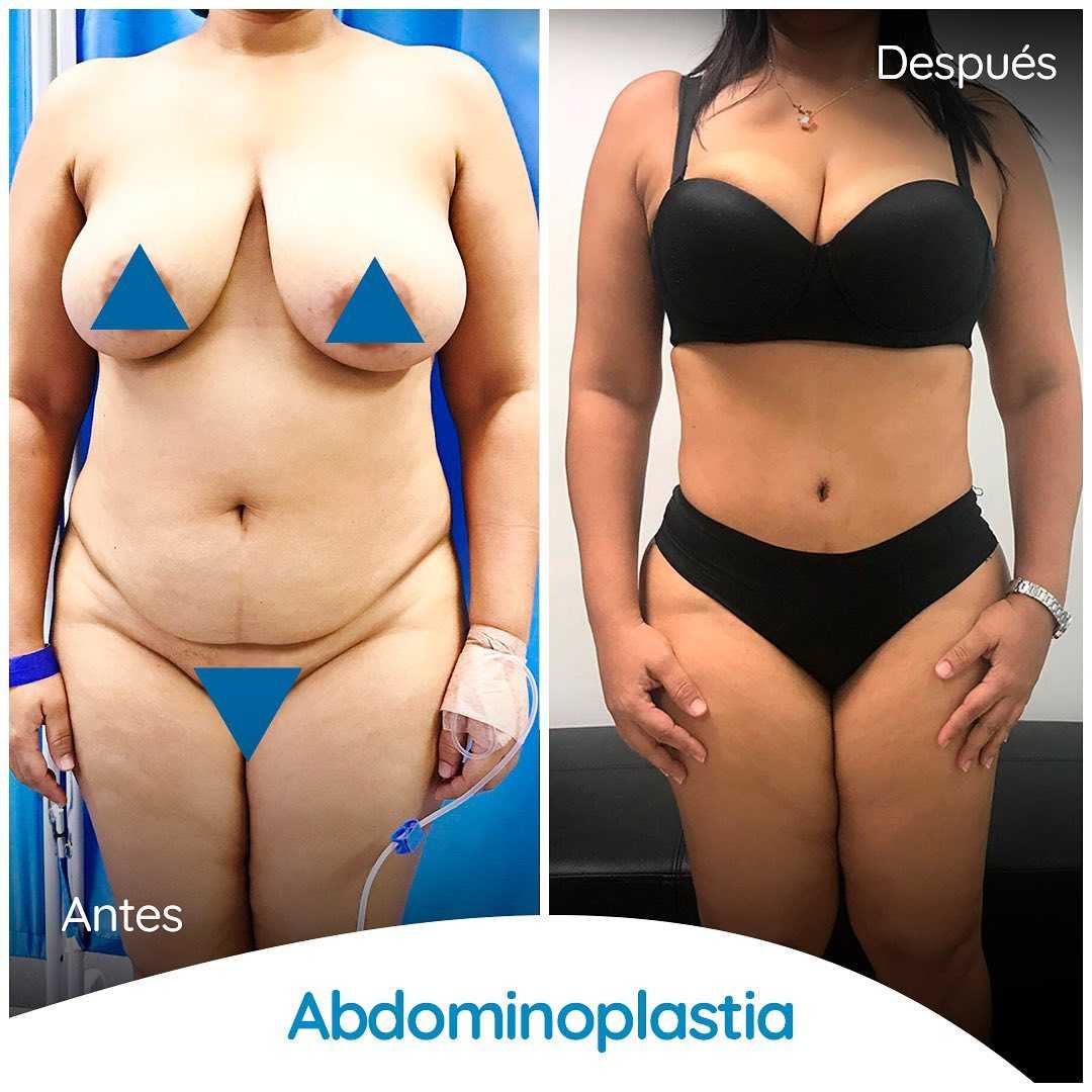 Imagen de antes y después de abdominoplastia en Colombia