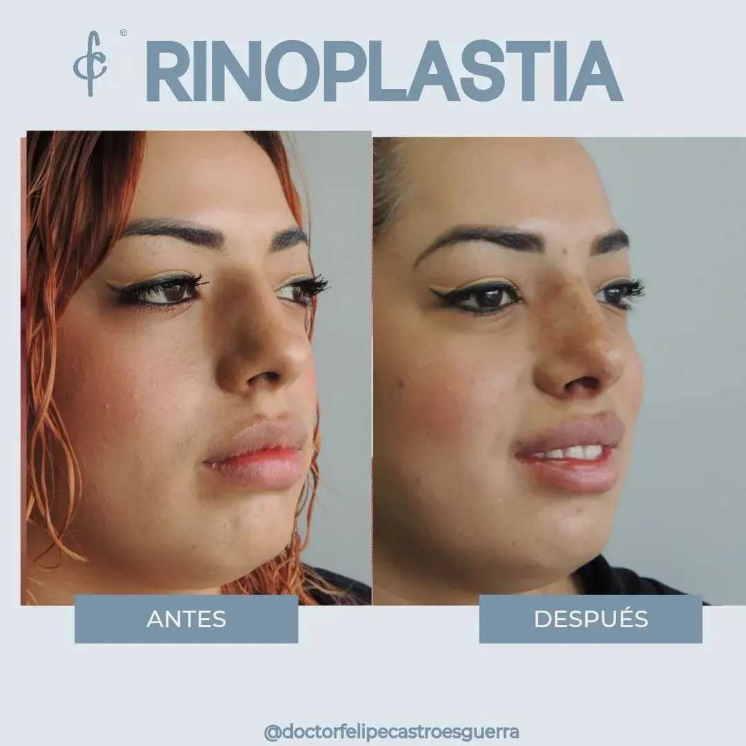 Rhinoplasty in Bogota Colombia Package