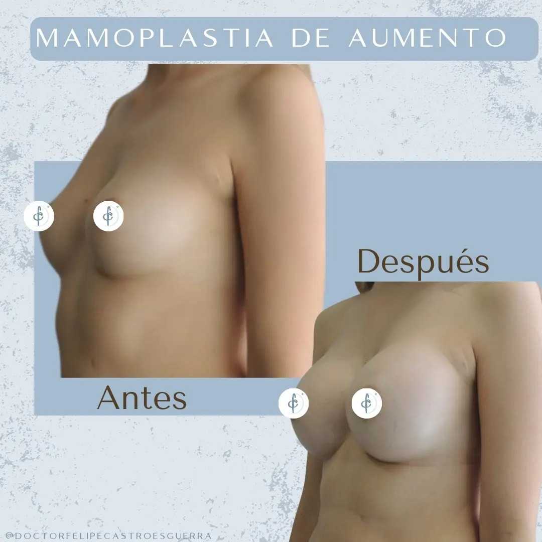 Breast Augmentation Package in Bogota Colombia