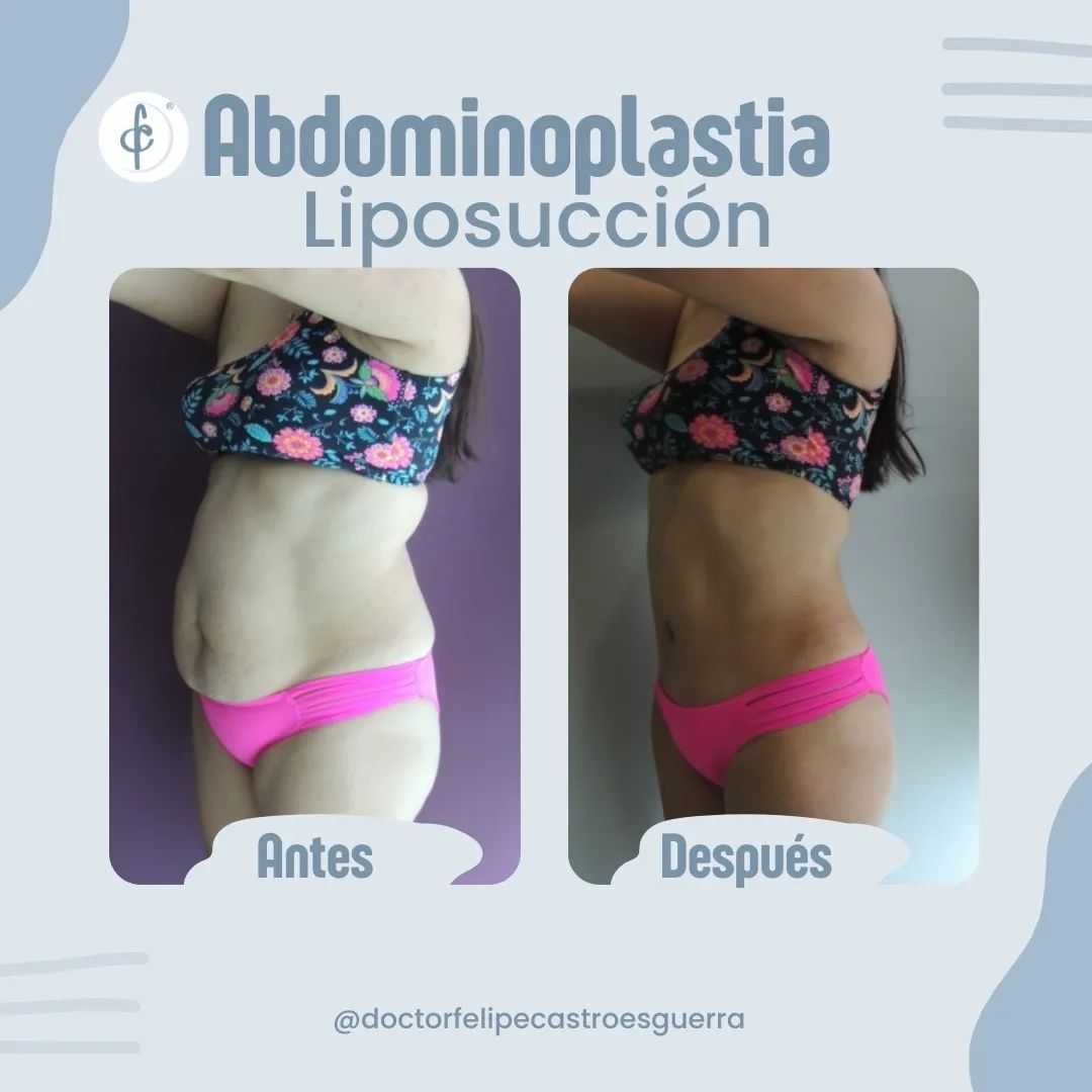 Paquete de Liposucción en Bogotá Colombia