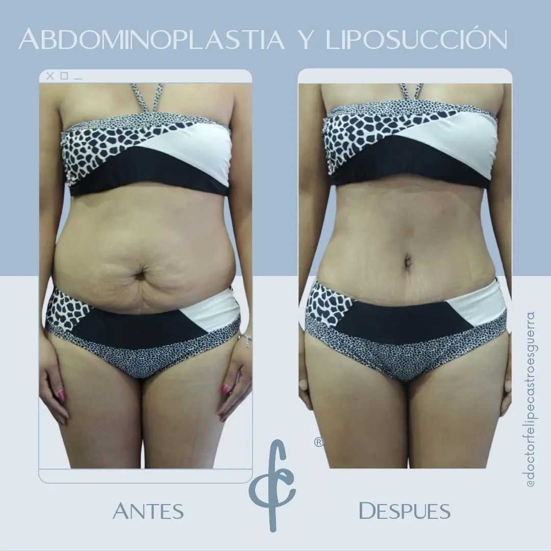 Paquete de Abdominoplastia en Bogotá Colombia