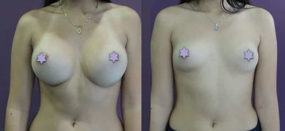 Breast Reduction Package in Bogota, Colombia by Dr. Felipe Castro