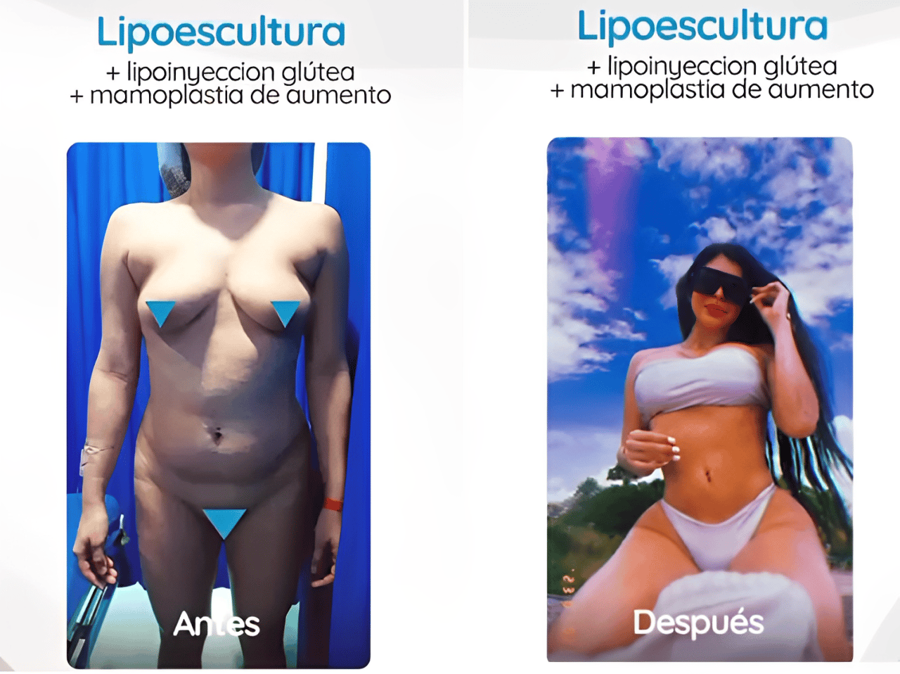 Paquete Lipoescultura Colombia por el Dr. Uribe