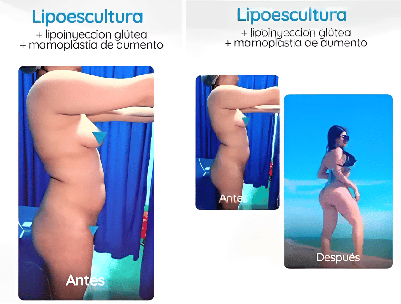 Liposculpture Colombia by Dr. Alvaro Uribe