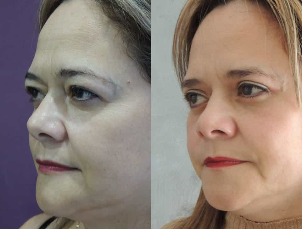 Paquete de lifting facial en Bogotá Colombia