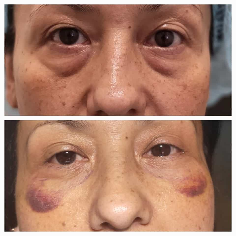 Eyelid Surgery Package in Bogota Colombia