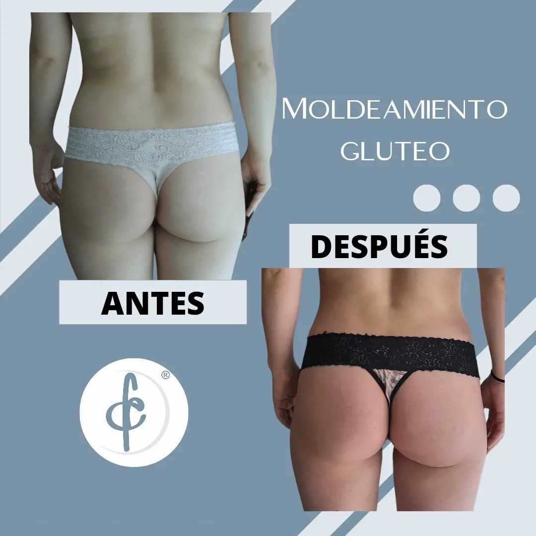 Buttock Augmentation Package in Bogota Colombia