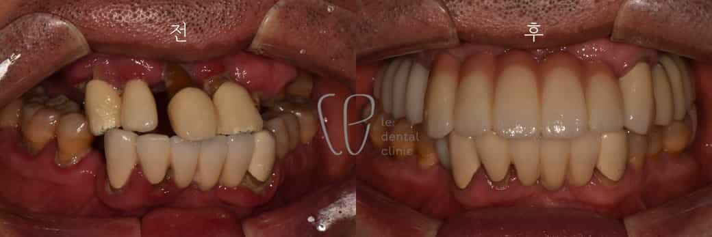 before and after dental care in seoul south korea