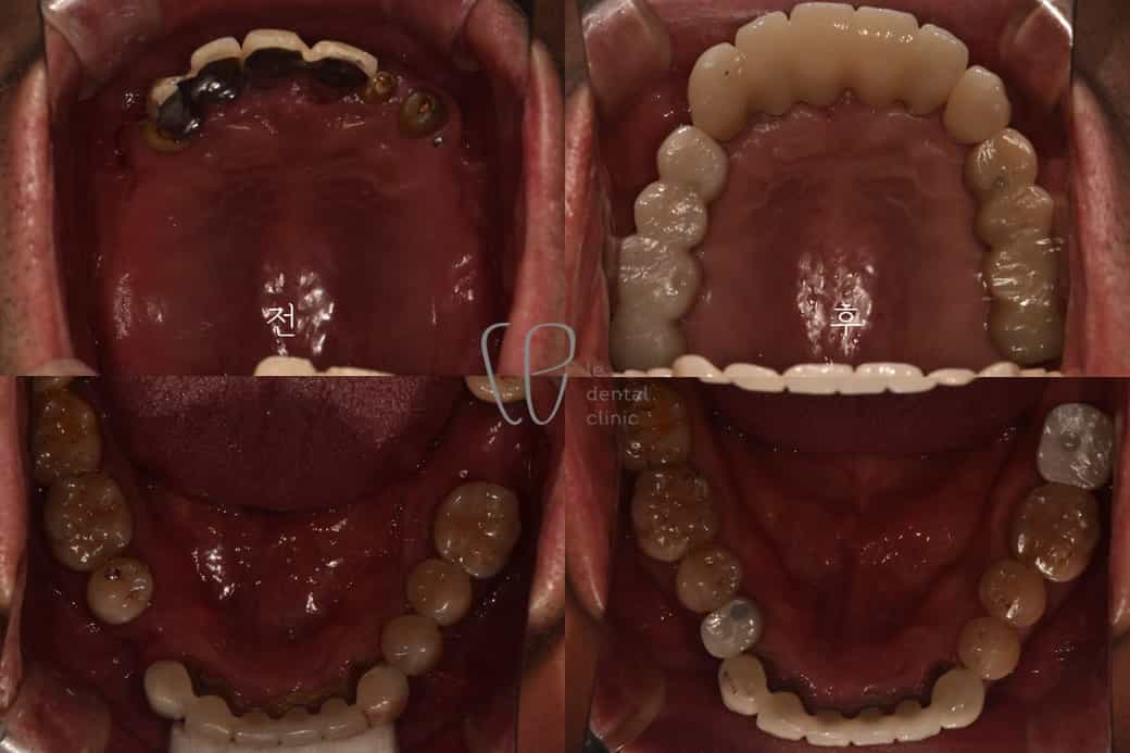 before and after dental treatment in seoul south korea