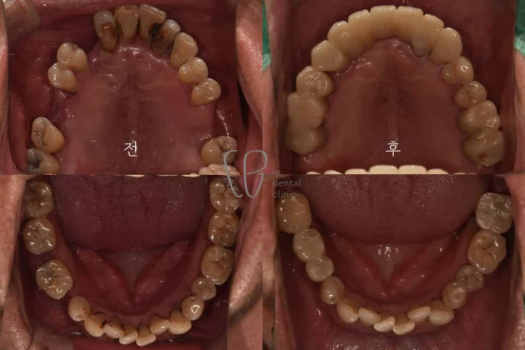 before and after dental care in seoul