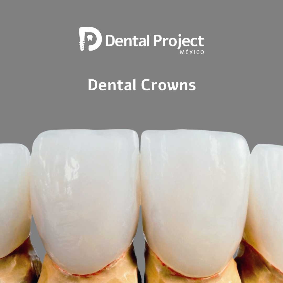 Dental Crowns Package in Tijuana Mexico