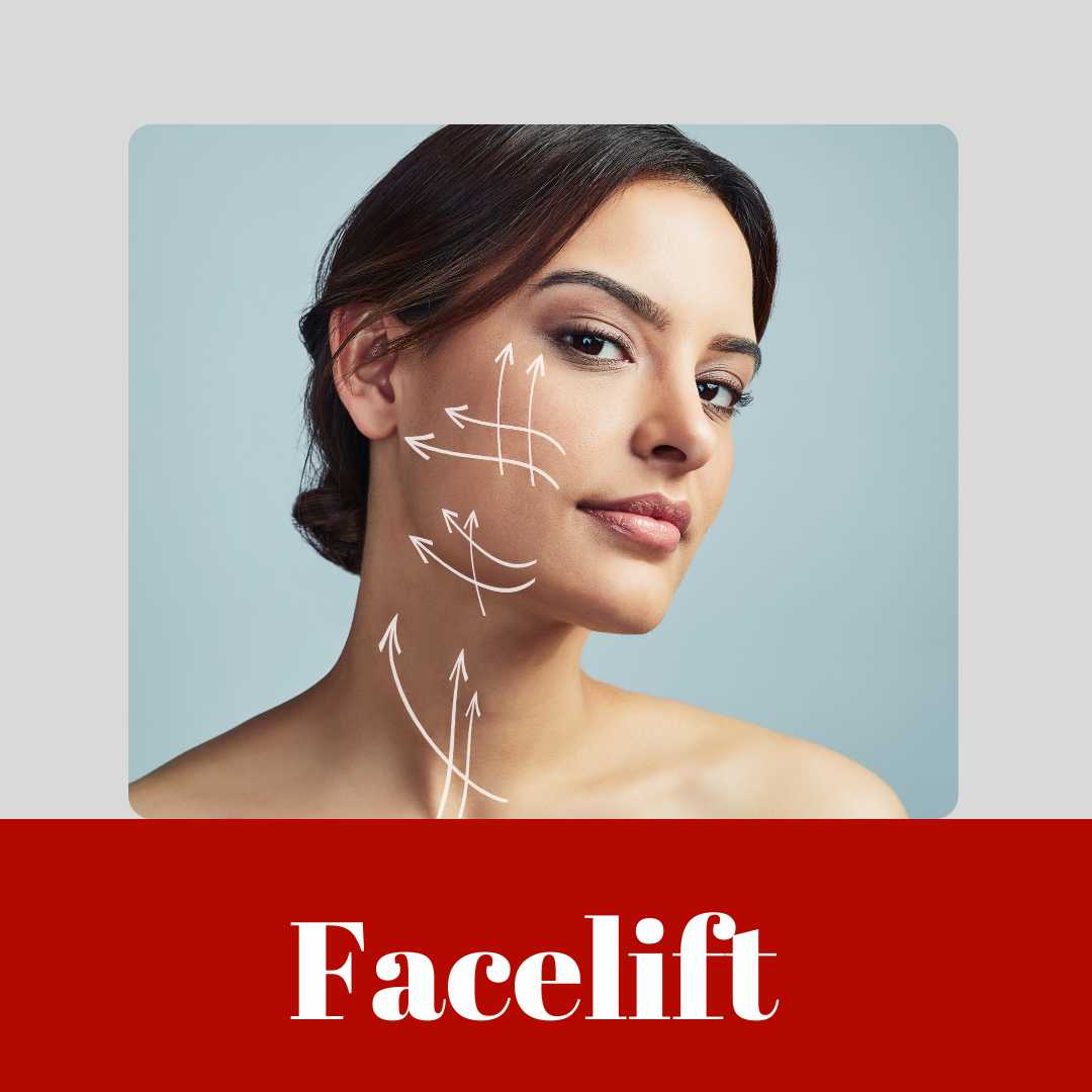 Facelift 