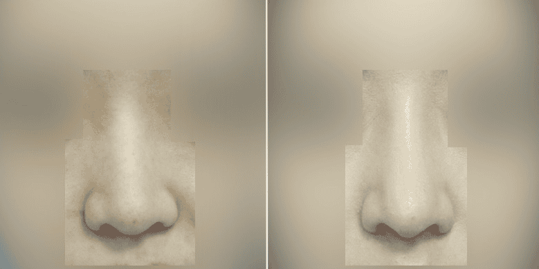 Before and After Images Results of Plastic Surgery in Seoul South Korea