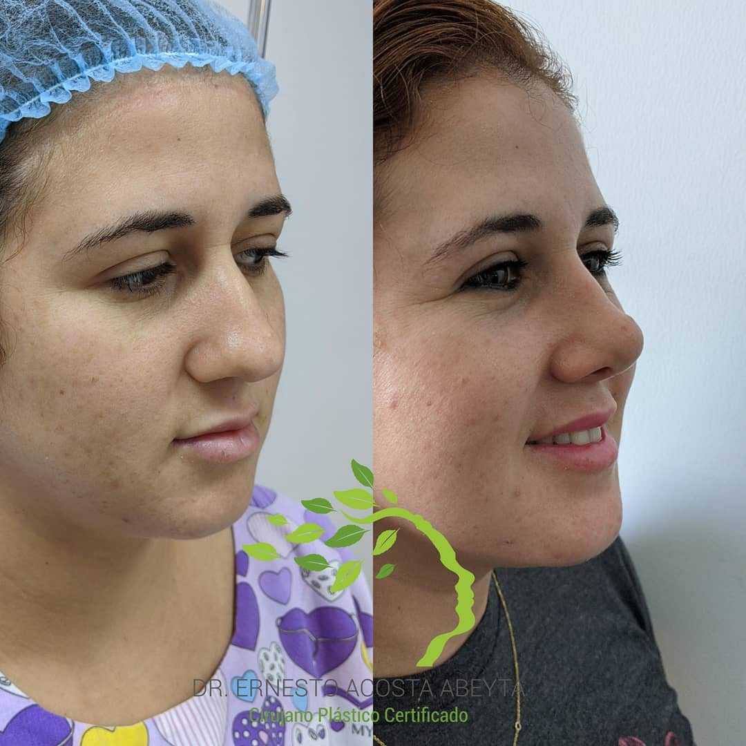 Before and After Image for Rhinoplasty in Merida, Mexico