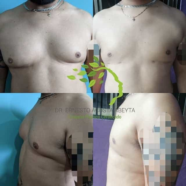 Before and After Image for Gynecomastia in Merida, Mexico