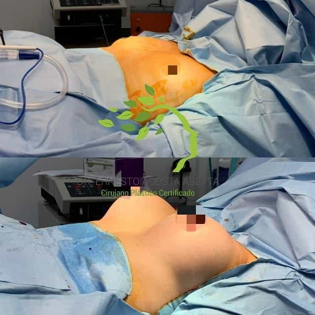 Before and After Picture of Breast Lift in Merida, Mexico